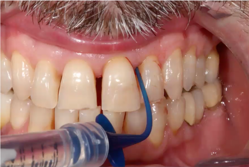 Pocket X® Gel - 501134