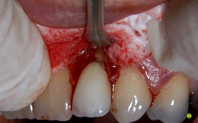 Scollaperiosteo Molt - ST-14421.02
