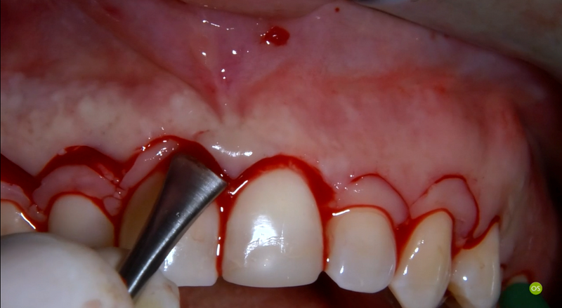 Scollaperiosteo Molt - ST-14421.02